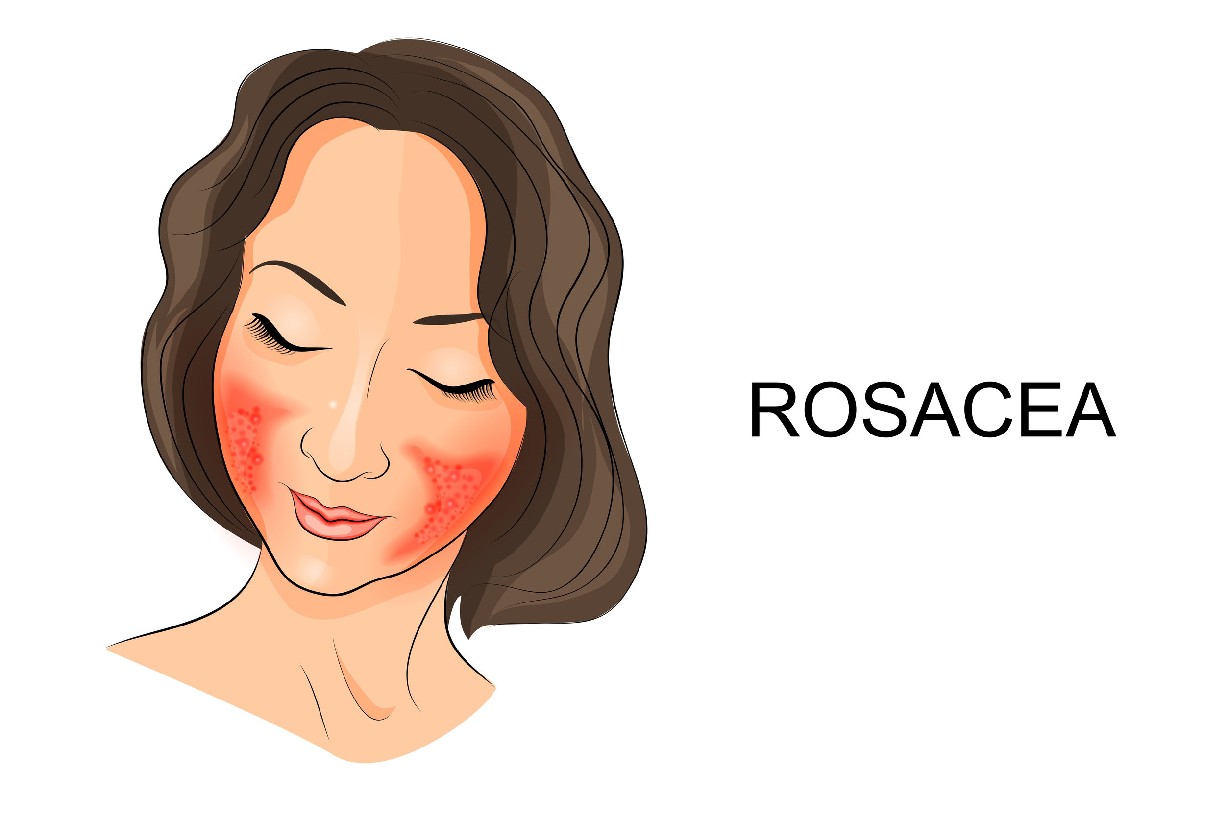 How To Use Soothing Coconut Oil For Rosacea (and does it work?)